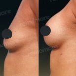 Before and after mammoplasty results at Memorial Şişli Hospital, visible breast enhancement