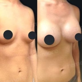 Before and after mammoplasty results at Memorial Şişli Hospital, visible breast augmentation