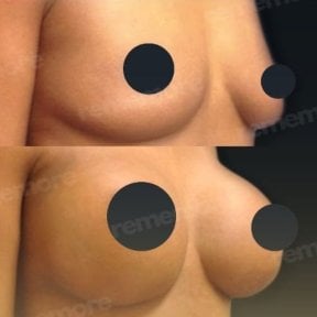 Before and after mammoplasty results at Memorial Şişli Hospital, visible breast augmentation