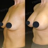 Before and after mammoplasty results at Memorial Şişli Hospital, visible breast enhancement