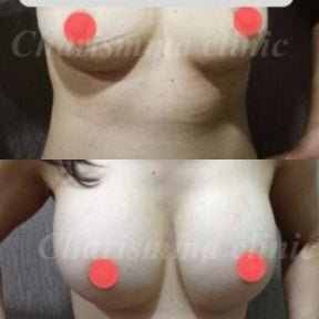 Before and after breast augmentation with fat transfer results at Charismma Clinic
