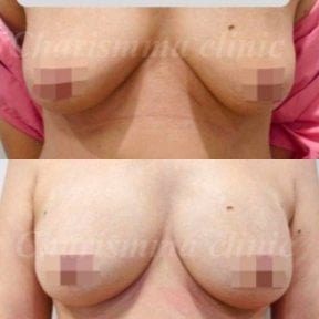 Before and after breast augmentation with fat transfer results at Charismma Clinic