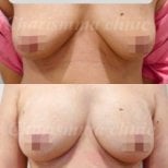 Before and after breast augmentation with fat transfer results at Charismma Clinic