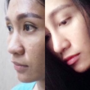 Before and after rhinoplasty results at Charismma Clinic, nose reshaping for natural look