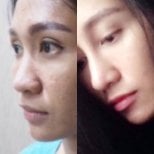 Before and after rhinoplasty results at Charismma Clinic, nose reshaping for natural look