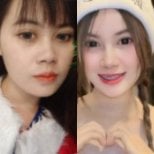 نتائج تجميل الأنف قبل وبعد في Charismma Clinic، إعادة تشكيل الأنف بمظهر طبيعي