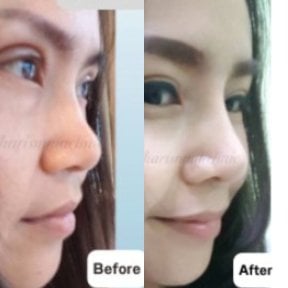 نتائج عملية تجميل الأنف قبل وبعد في Charismma Clinic، إعادة تشكيل طبيعية للأنف