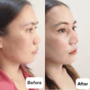 نتائج تجميل الأنف قبل وبعد في Charismma Clinic، تحسين شكل الأنف والملامح