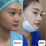 نتائج عملية تجميل الأنف قبل وبعد في Charismma Clinic، تحسين شكل الأنف والملف الجانبي