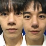 Before and after open rhinoplasty results at Charismma Clinic, nose reshaping improvement