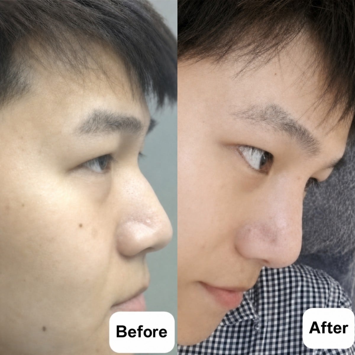 Resultados antes y después de rinoplastia abierta en Charismma Clinic, forma de nariz mejorada