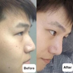 Before and after open rhinoplasty results at Charismma Clinic, improved nose shape