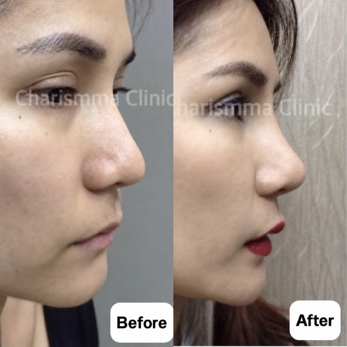 نتائج قبل وبعد عملية تجميل الأنف المفتوحة في Charismma Clinic، تحسين شكل الأنف
