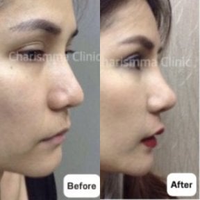 Before and after open rhinoplasty results at Charismma Clinic, improved nose shape