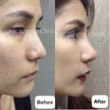 Before and after open rhinoplasty results at Charismma Clinic, improved nose shape