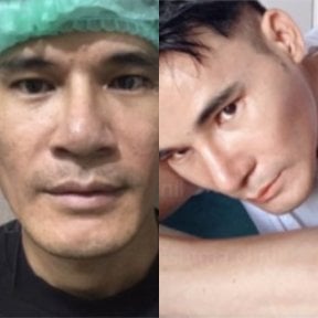 Before and after open rhinoplasty result at Charismma Clinic, improved nose shape and contour