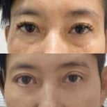 Before and after upper and lower eyelid surgery results at Charismma Clinic, rejuvenated eyes