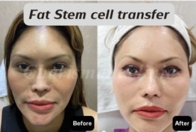 Before and after facial fat stem cell transfer results at Charismma Clinic, rejuvenation effect