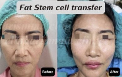 Before and after facial fat transfer results at Charismma Clinic, improved facial volume