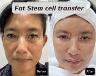 Before and after facial fat transfer results at Charismma Clinic – rejuvenated skin appearance