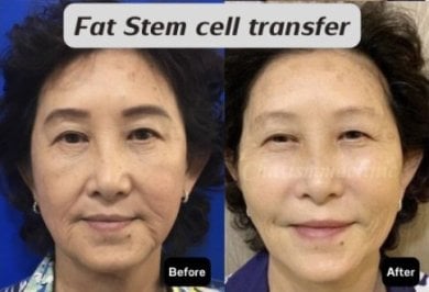 Before and after facial fat transfer results at Charismma Clinic, improved facial volume