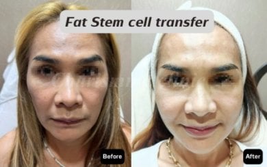 Before and after facial fat transfer results at Charismma Clinic – rejuvenated appearance