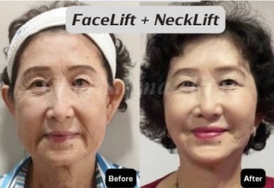 Resultados de lifting facial y de cuello antes y después en Charismma Clinic, rejuvenecimiento
