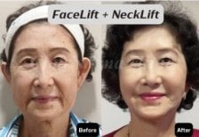 Resultados de lifting facial y de cuello antes y después en Charismma Clinic, rejuvenecimiento
