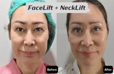 Resultados antes y después de lifting facial y de cuello en Charismma Clinic, rejuvenecimiento facial