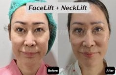 Resultados antes y después de lifting facial y de cuello en Charismma Clinic, rejuvenecimiento facial