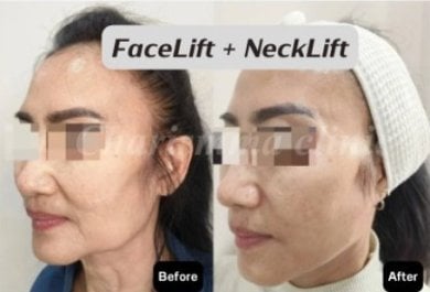 Resultados de lifting facial y de cuello antes y después en Charismma Clinic, rejuvenecimiento visible