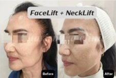 Resultados de lifting facial y de cuello antes y después en Charismma Clinic, rejuvenecimiento visible