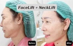 Resultados de lifting facial y de cuello antes y después en Charismma Clinic, rejuvenecimiento visible
