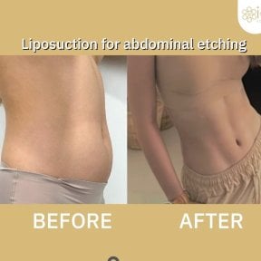 Before and after Vaser liposuction for abdominal etching results at ID Clinic Bangkok
