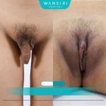 Resultados antes y después de cirugía de reasignación de sexo en Wansiri Hospital, transformación visible