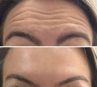 Vorher-nachher Botox-Injektionen bei Odontoliuzzi Dentistry and Health, glattere Stirn