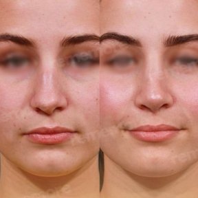 Before and after rhinoplasty results at Memorial Ankara Hospital, nose reshaping improvement