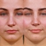 Before and after rhinoplasty results at Memorial Ankara Hospital, nose reshaping improvement