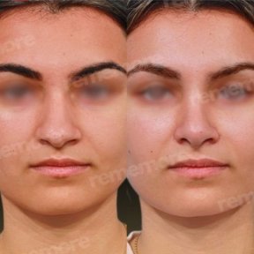 Before and after rhinoplasty results at Memorial Ankara Hospital, improved nose shape