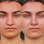 Before and after rhinoplasty results at Memorial Ankara Hospital, improved nose shape