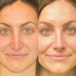 Before and after rhinoplasty results at Memorial Ankara Hospital, nose reshaping procedure