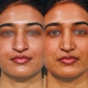 Before and after rhinoplasty results at Memorial Ankara Hospital, nose reshaping improvement