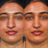 Before and after rhinoplasty results at Memorial Ankara Hospital, nose reshaping improvement