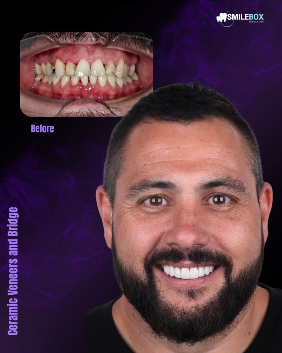 Resultado antes y después de carillas cerámicas y puente en SmileBox Dental Clinic - Thonglor
