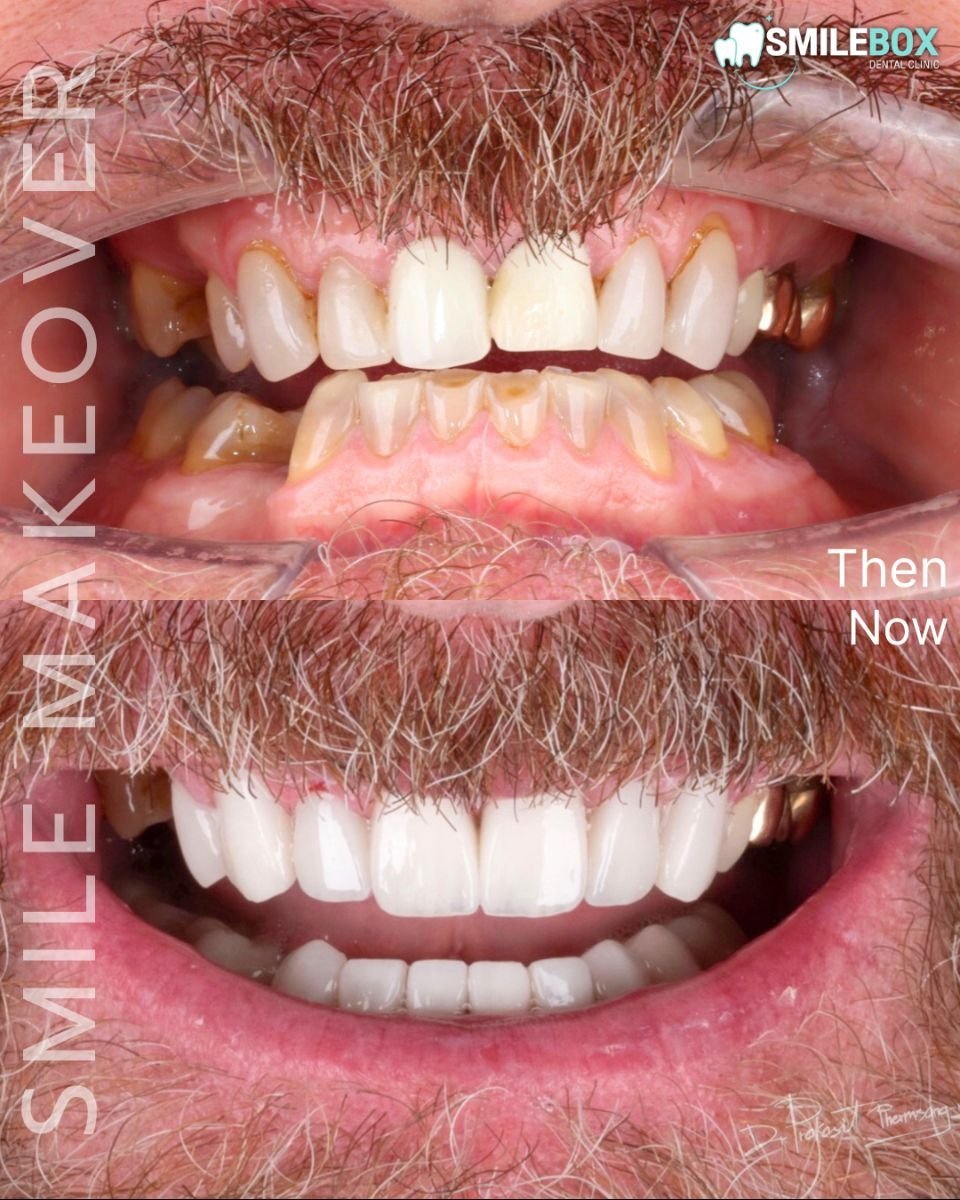 Результаты до и после улыбки с винирами в SmileBox Dental Clinic Thonglor