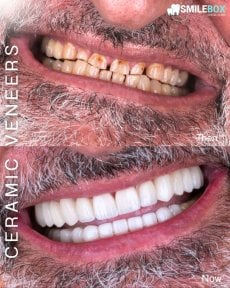 Résultat avant/après facettes céramiques à SmileBox Dental Clinic - Thonglor, Sukhumvit Branch