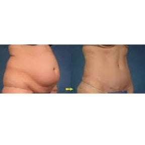 Before and after liposuction results at Odontoliuzzi Dentistry and Health, flatter abdomen
