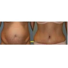 Before and after liposuction results at Odontoliuzzi Dentistry and Health, improved waist contour