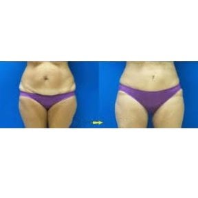 Before and after liposuction results at Odontoliuzzi Dentistry and Health, improved body contour