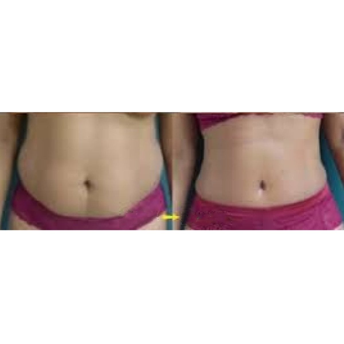 Resultados de liposucción antes y después en Odontoliuzzi Dentistry and Health, abdomen